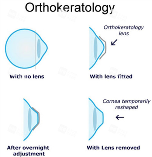 合肥配角膜塑形鏡去哪家好？沃瑞/東南/慧視/普瑞性價(jià)比較高，收費(fèi)親民不踩雷！近視矯正必看攻略！