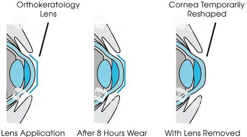 角膜塑形鏡矯正眼睛流程圖
