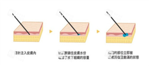 廣州注射微整哪家好？預(yù)算1W，對(duì)比荔灣/高尚，平價(jià)vs定制化注射思路不同！