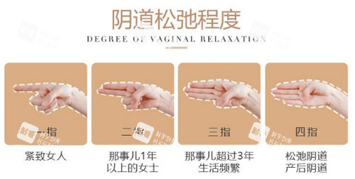 陰道松弛程度圖示