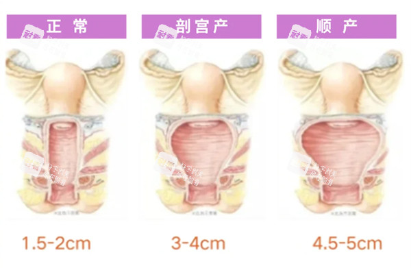 正常陰道和松弛對(duì)比照片