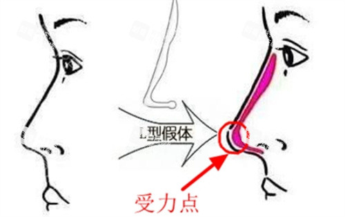 L形隆鼻假體對比