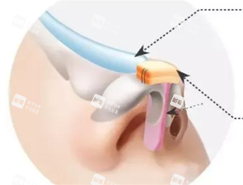 隆鼻假體植入鼻背動畫展示圖