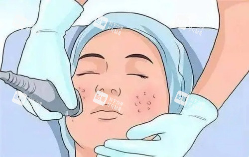 激光面部祛痣示意圖