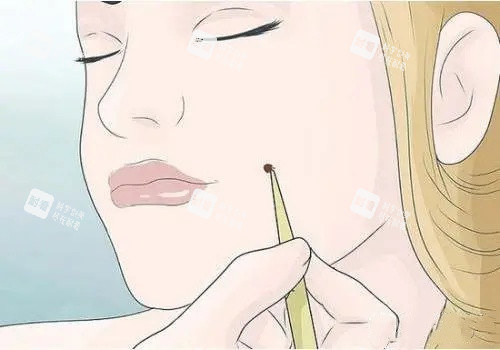 面部祛痣漫畫示意圖