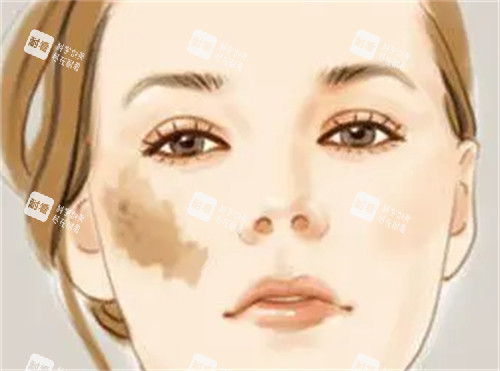 鮮紅斑痣的樣子