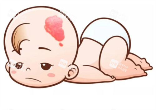 新生兒鮮紅斑痣