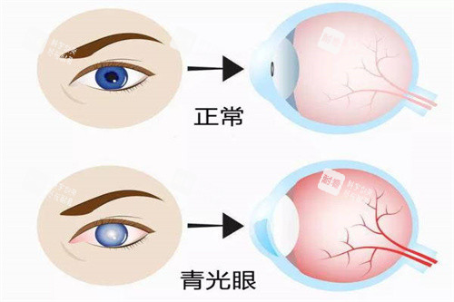 青光眼與正常眼睛對比圖