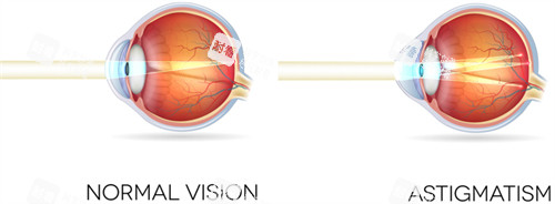 正常眼鏡和散光眼睛區(qū)別