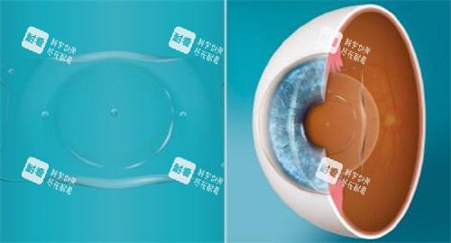 人工晶體植入眼睛的層次