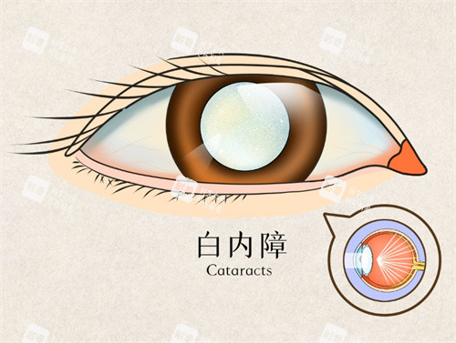 白內(nèi)障手術圖片