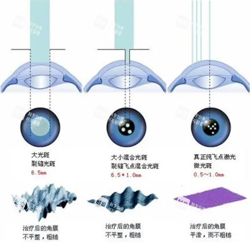 近視手術(shù)對(duì)比
