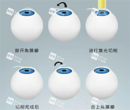 半飛秒手術(shù)過(guò)程