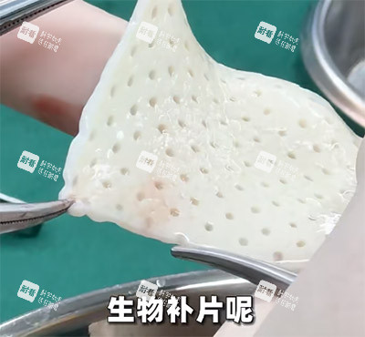 生物補片改善增大增粗照片