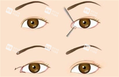 雙眼皮窄改寬修復(fù)