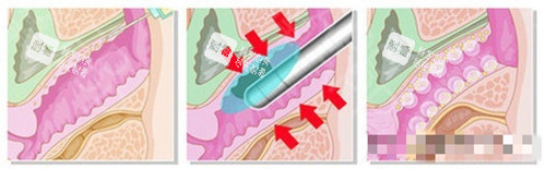 菲蜜麗過(guò)程卡通圖