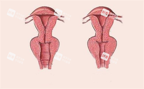 女性陰道松弛和緊致對(duì)比