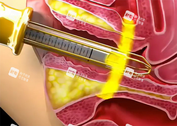 緊縮針緊縮推藥照片