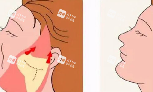 拉皮手術(shù)的術(shù)后對(duì)比圖