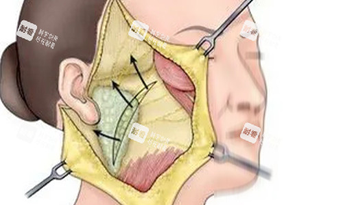 拉皮手術(shù)剖開動(dòng)畫示意圖