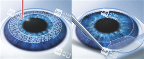 哈爾濱華廈眼科醫(yī)院做全飛秒多少錢？全飛秒活動(dòng)價(jià)格17800元很實(shí)惠，可以搶名額！