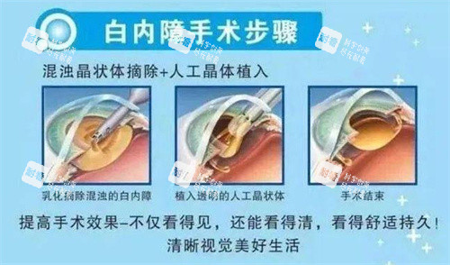 白內(nèi)障手術(shù)示意圖