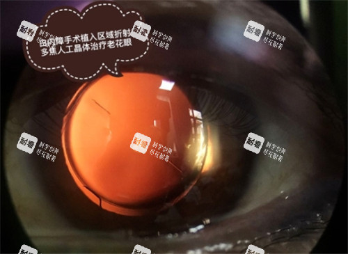 白內(nèi)障手術(shù)細(xì)節(jié)圖 (2)