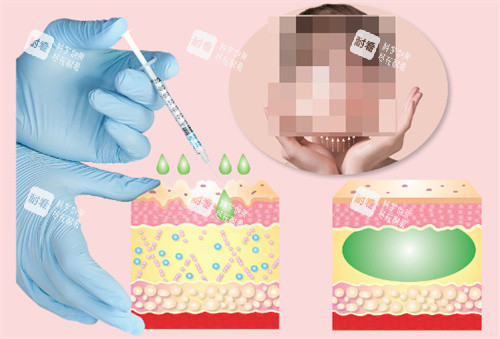 面部注射干細胞