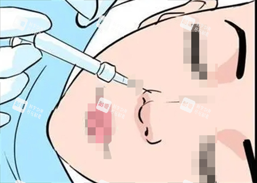 玻尿酸注射鼻子動(dòng)畫(huà)展示