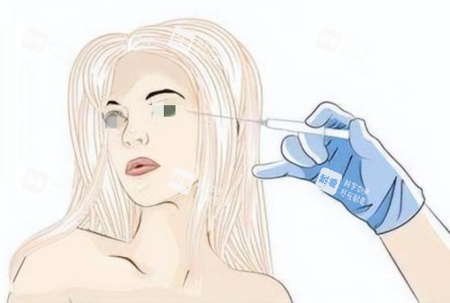 注射膠原蛋白去淚溝示意圖