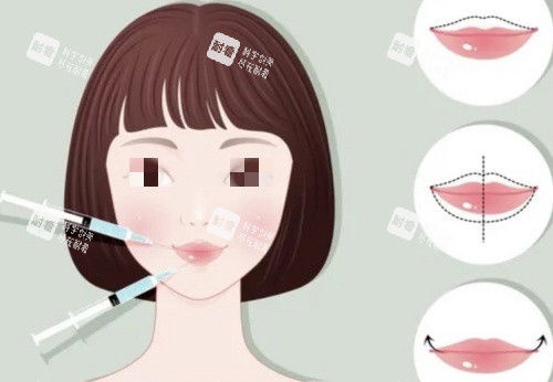 豐唇注射前后示意圖