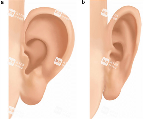 手術(shù)改善耳朵形狀前后對比