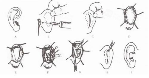 耳朵矯正手術(shù)