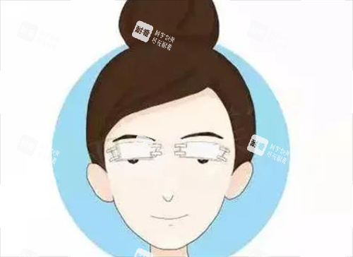 雙眼皮術(shù)后