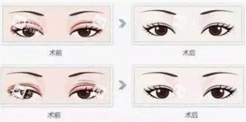 雙眼皮修復(fù)