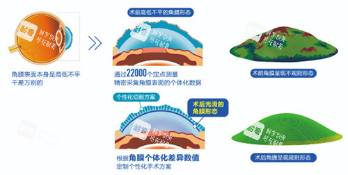 近視眼手術(shù)前后角膜變化示意圖