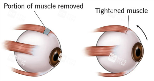 斜視眼睛肌肉和正常眼睛肌肉不同