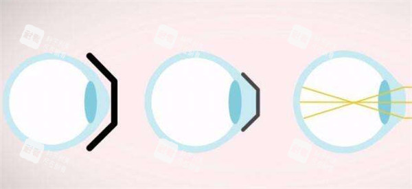 近視矯正過程中眼球的變化圖解