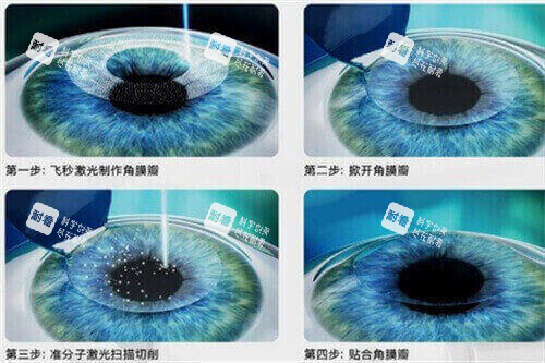 近視矯正手術(shù)過程示意圖