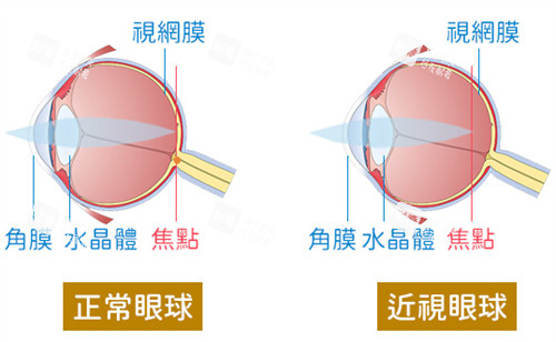 正常眼球和近視眼球的區(qū)別圖解