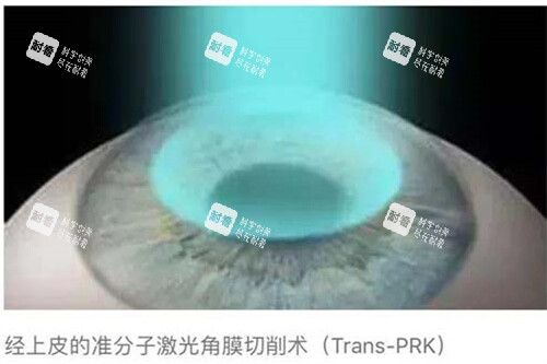 近視眼手術(shù)10