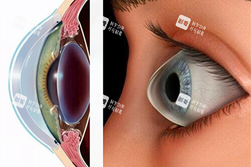近視眼球外突示意圖