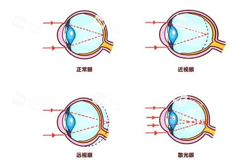 遠(yuǎn)視眼和近視眼的區(qū)別 遠(yuǎn)視眼和近視眼的區(qū)別