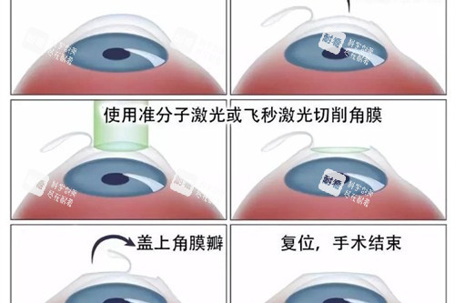 近視眼手術(shù)流程展示 近視眼手術(shù)流程展示