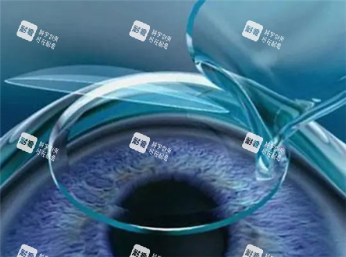 激光近視眼手術(shù)細(xì)節(jié)圖 激光近視眼手術(shù)細(xì)節(jié)圖