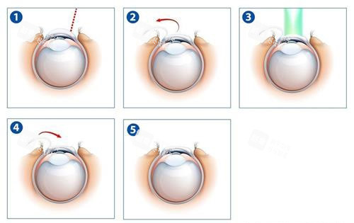 激光近視眼手術(shù)示意圖 激光近視眼手術(shù)示意圖