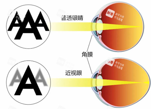 近視眼鏡與正常眼睛視物區(qū)別 近視眼鏡與正常眼睛視物區(qū)別