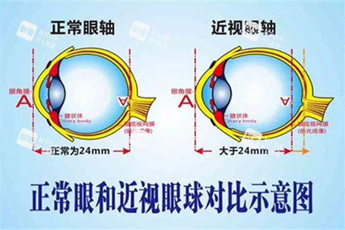 正常眼和近視眼球?qū)Ρ仁疽鈭D 正常眼和近視眼球?qū)Ρ仁疽鈭D