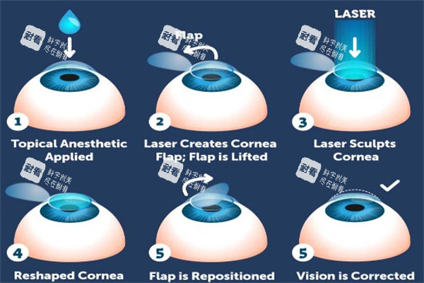 激光治療近視眼動畫圖