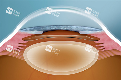 晶體植入手術(shù)動(dòng)畫(huà)圖